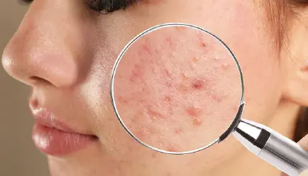 Acne Removal Treatment in Bhubaneswar