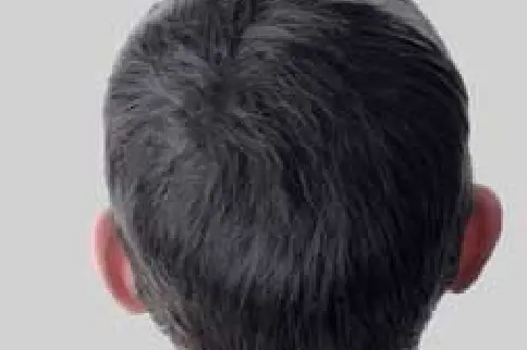 After GFC Hair Loss Treatment