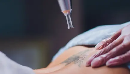 Tattoo Removal Treatment in Bhubaneswar