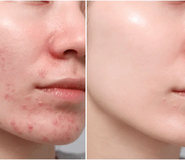 Carbon Peel for Rosacea Treatment