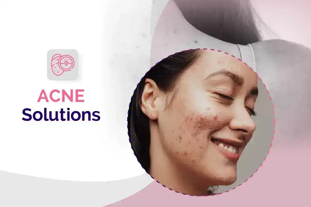 Acne Treatment in Bhubaneswar