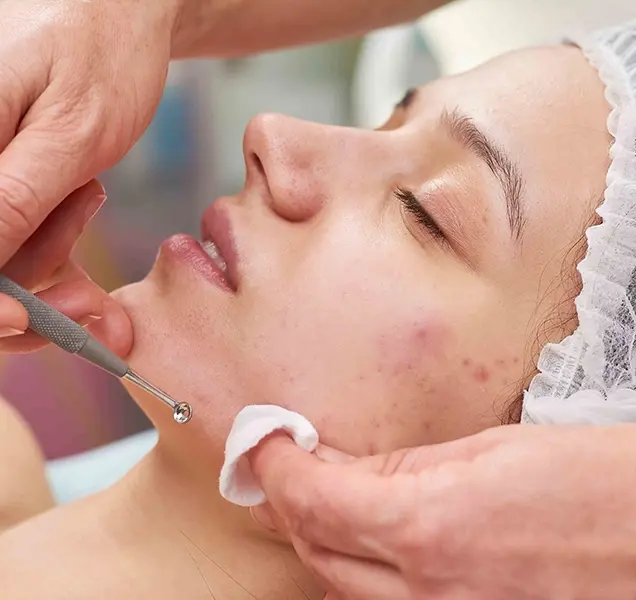 Carbon Peel for Rosacea Treatment