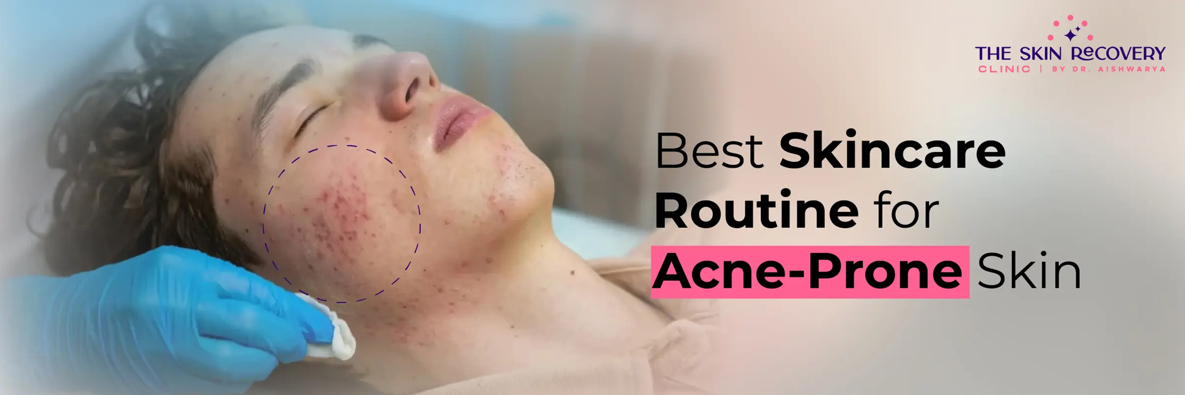 Best Skincare Routine for Acne