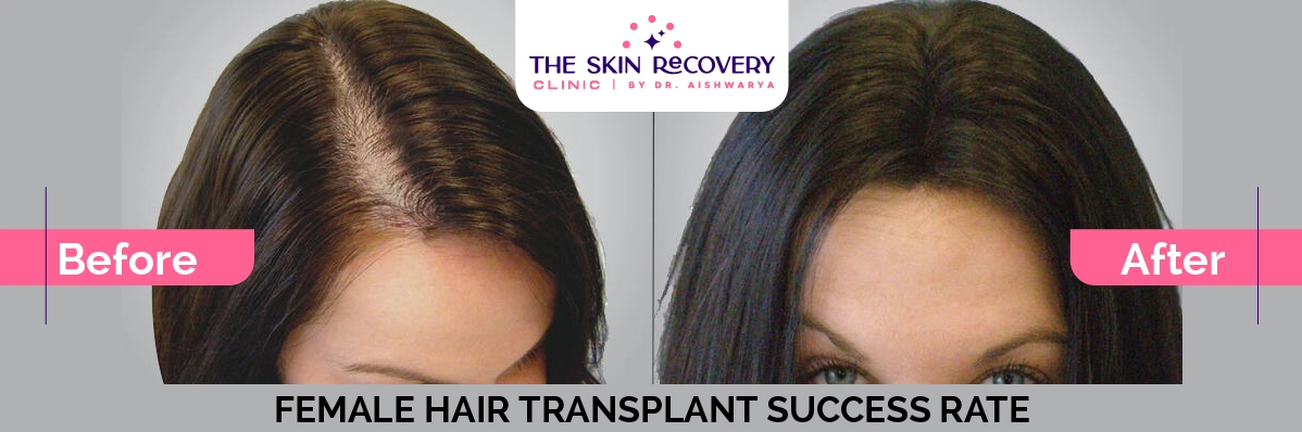 Female Hair Transplant Success Rate