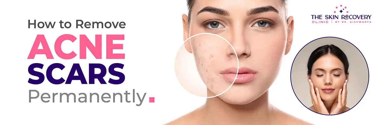 How to Remove Acne Scars Permanently