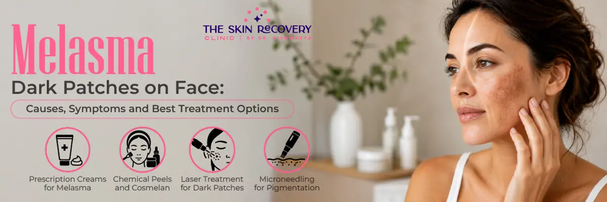 Dark Facial Patches Caused by Melasma