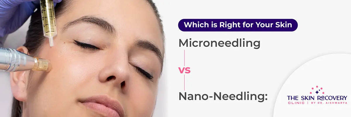 How to Remove Acne Scars Permanently