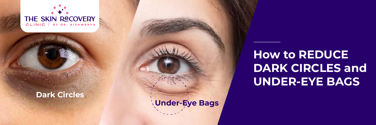 Reduce Dark Circles and Under-Eye Bags