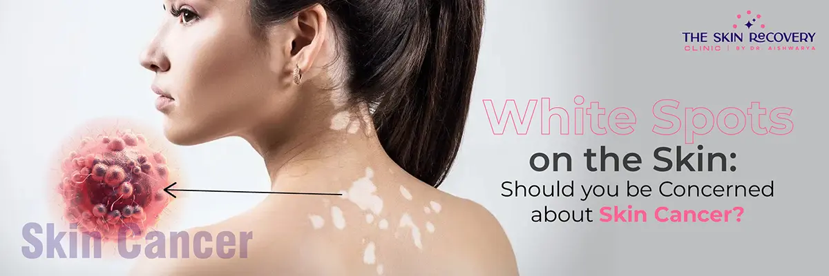 White Spots on the Skin