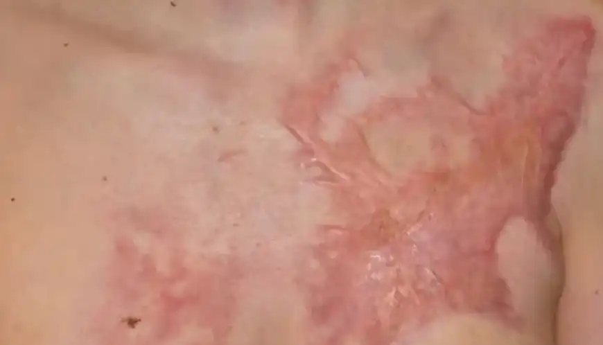 Burn Scars Removal Before