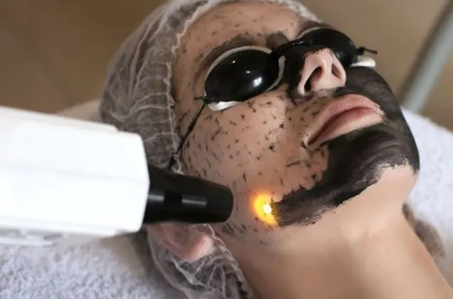 before carbon laser treatment