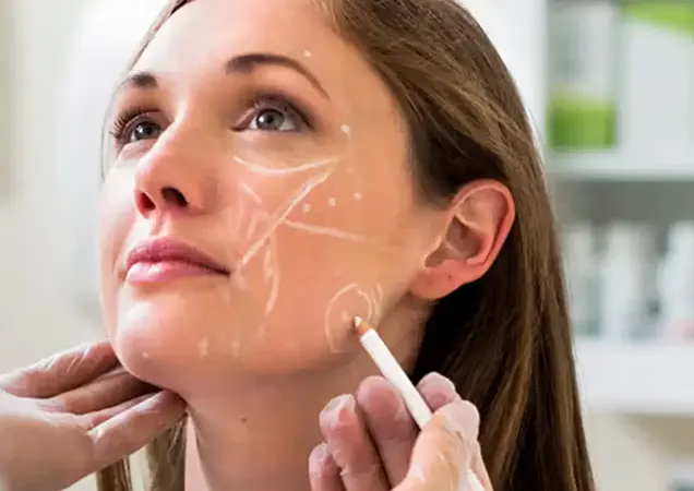 Carbon Peel for Rosacea Treatment