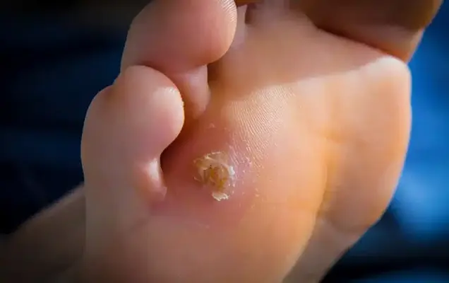 Corn Removal Surgery Bhubaneswar