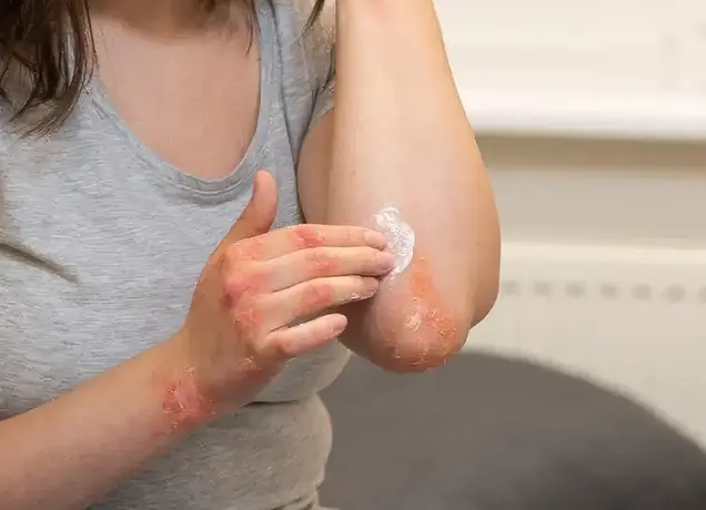 Dermatitis Treatment in Bhubaneswar