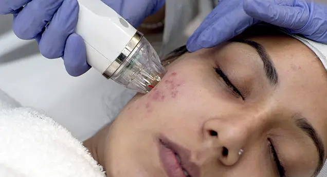 Acne Scar Removal in Bhubaneswar