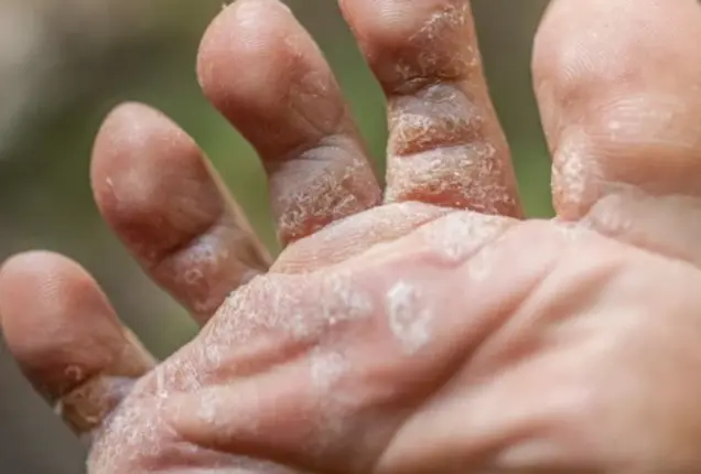 Fungal Infection Treatment In Bhubaneswar