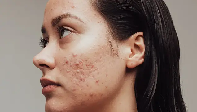 Before Freckles Treatment