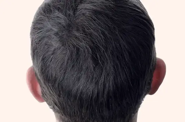 After GFC Hair Loss Treatment