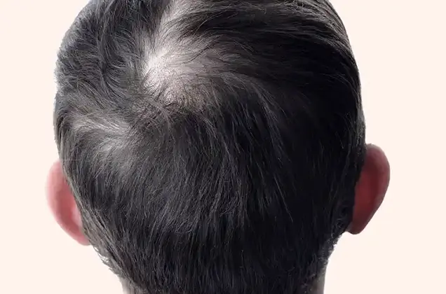 Before GFC Hair Loss Treatment