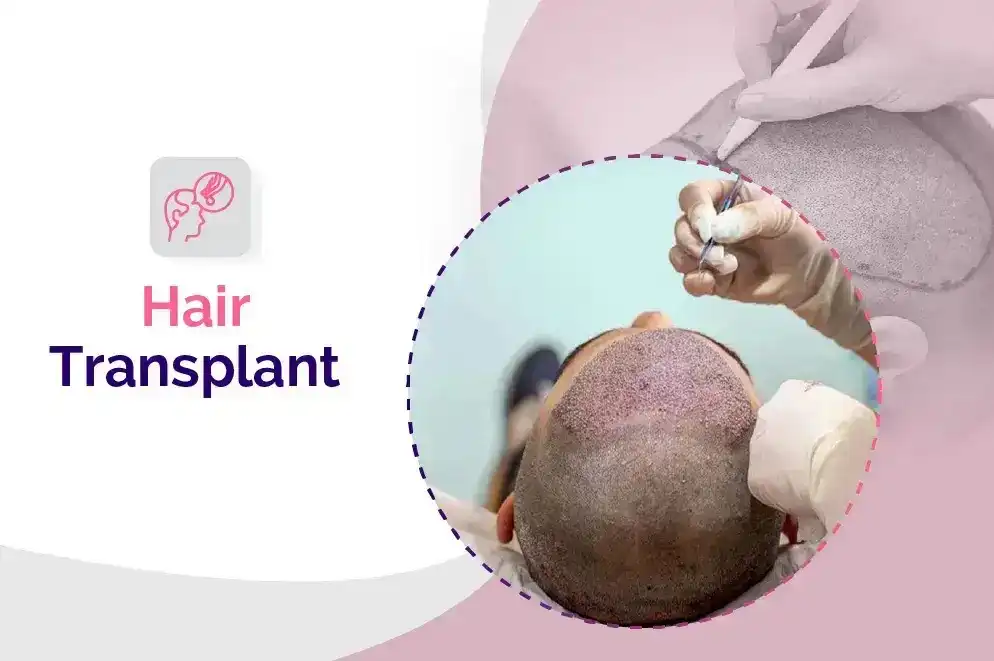 Hair Transplant in Bhubaneswar