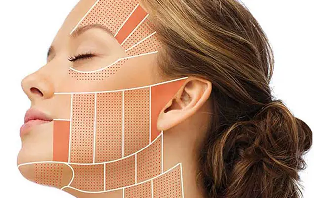 HIFU face lifting treatment areas