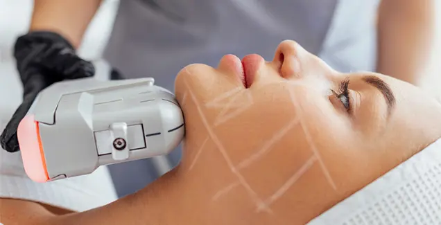 HIFU ultrasound skin lifting treatment