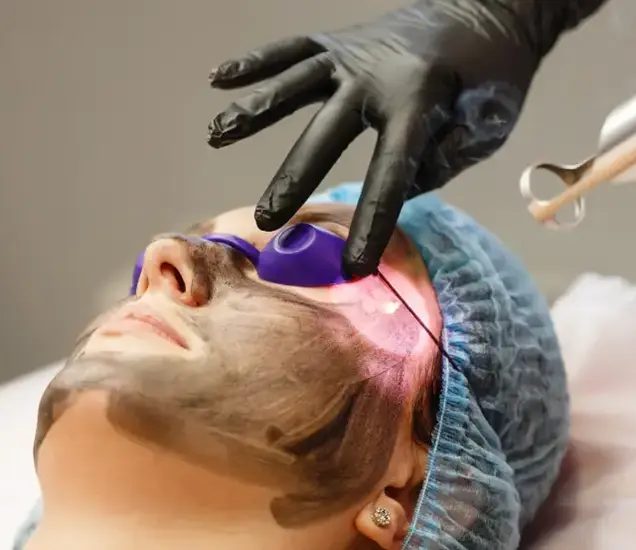 Hollywood carbon peel laser facial treatment on patient face