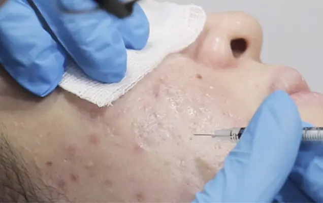 Acne Scar Removal in Bhubaneswar
