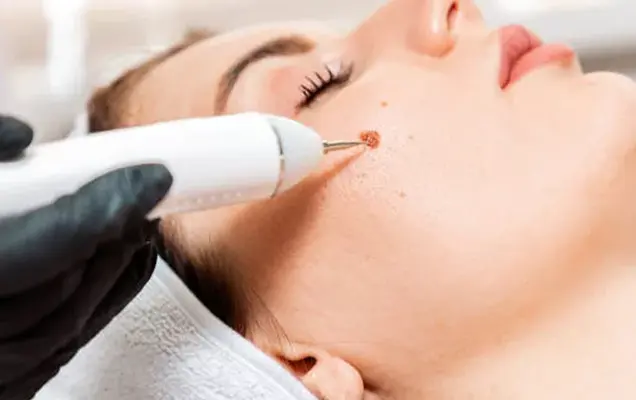 Birthmarks removal treatment in bhubaneswar