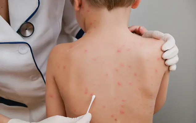 Chicken Pox Scar Removal Treatment in Bhubaneswar