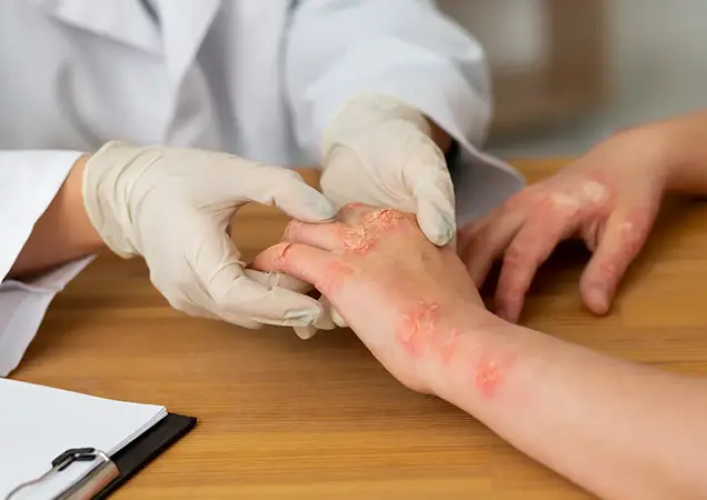 Dermatitis Treatment in Bhubaneswar
