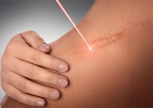 Technique Used for Keloid Treatment