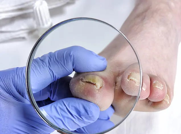 Nail Infection Treatment in Bhubaneswar