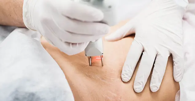 Stretch Marks Removal in Bhubaneswar