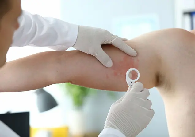 Urticaria Doctor in Bhubaneswar