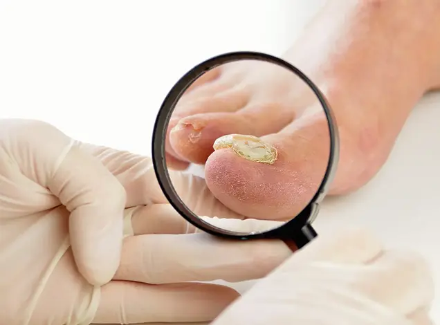 Fungal Infection Treatment In Bhubaneswar