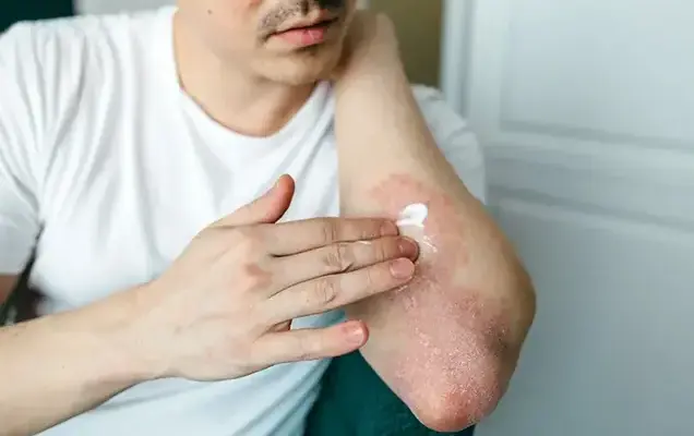 Carbon Peel for Rosacea Treatment