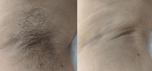 Laser Hair Removal After