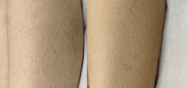 Leg Hair Removal Treatment Bhubaneswar
