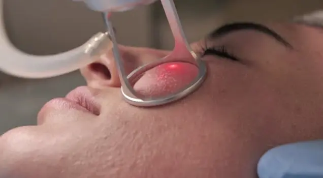 Carbon Peel for Rosacea Treatment