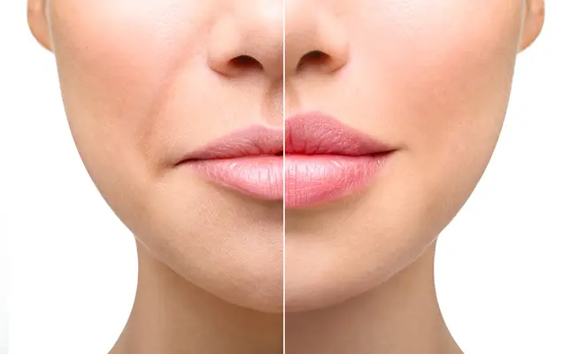 Lip Enhancement Treatment in Bhubaneswar