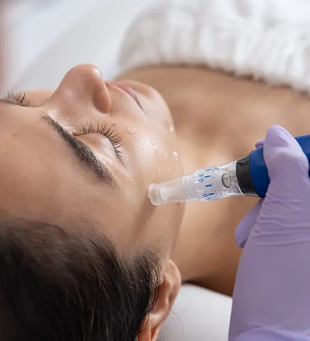 Microneedling Treatment