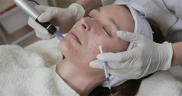 microneedling facial treatment for acne scars