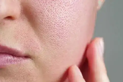 before open pores treatment