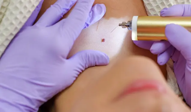 Best Mole Treatment Doctor Bhubaneswar