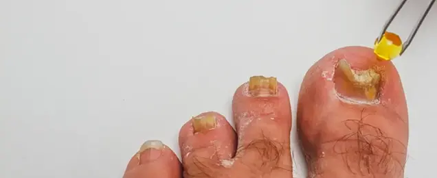 Nail Infection Treatment in Bhubaneswar