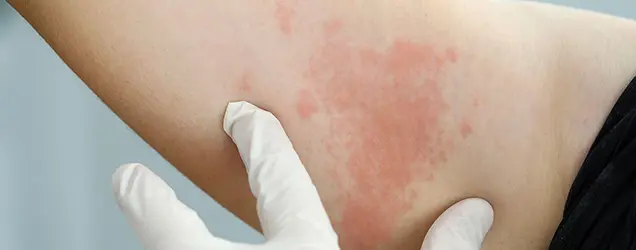 Urticaria Doctor in Bhubaneswar