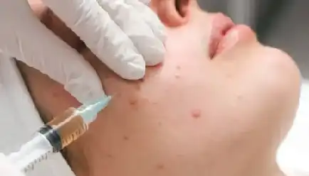 Before PRP Treatment for Skin