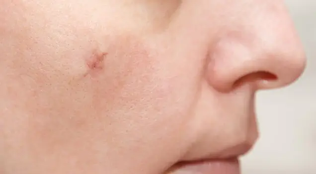 Best Mole Treatment Doctor Bhubaneswar