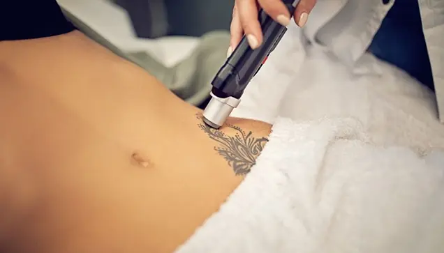 Before Tattoo Removal Treatment